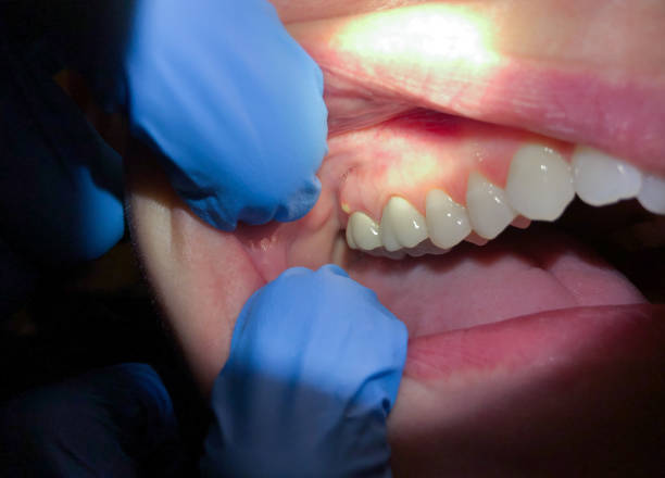 Best Emergency Dental Care for Broken or Chipped Teeth in Watergate, FL